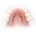 /album/fotogaleria-ortopedia-maxilar/quad-helix-jpg/